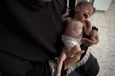 Recém-nascido na Faixa de Gaza em estado de desnutrição.