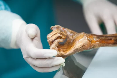 Mão mumificada de Ötzi o Homem do Gelo sendo examinada por cientistas. (Foto: phys.org)