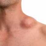 Anticorpo biespecífico redireciona o sistema imunológico para atacar células tumorais e amplia as possibilidades de tratamento no país.